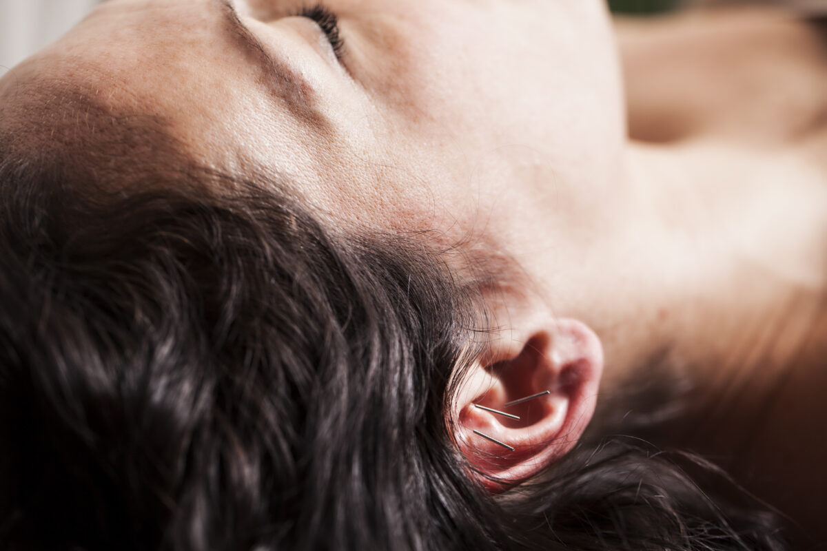 a woman receiving acupuncture therapy