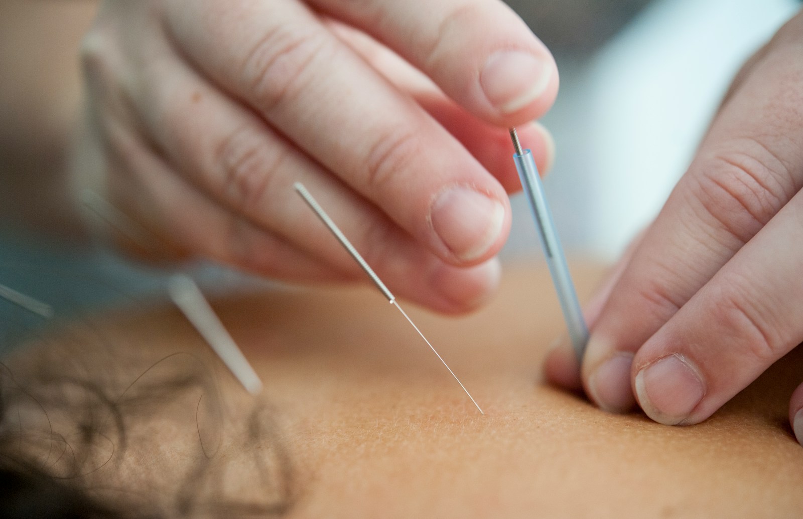 Treating Anxiety & Depression with Acupuncture